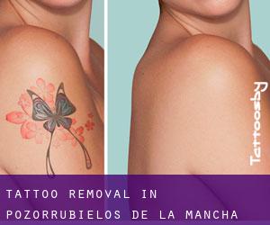 Tattoo Removal in Pozorrubielos de la Mancha