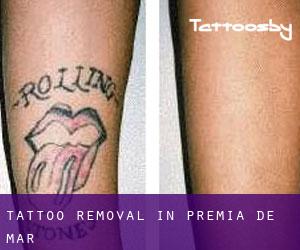 Tattoo Removal in Premià de Mar