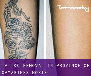 Tattoo Removal in Province of Camarines Norte