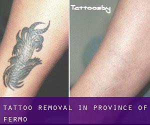 Tattoo Removal in Province of Fermo