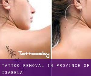 Tattoo Removal in Province of Isabela