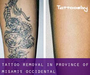 Tattoo Removal in Province of Misamis Occidental