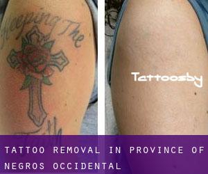 Tattoo Removal in Province of Negros Occidental