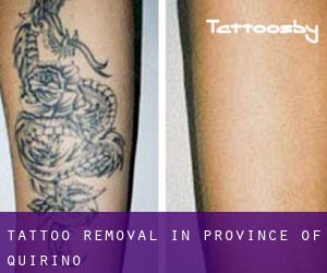 Tattoo Removal in Province of Quirino