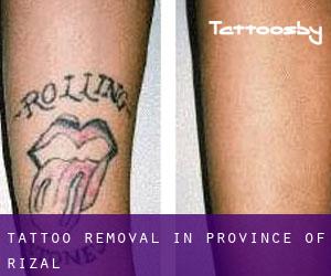 Tattoo Removal in Province of Rizal