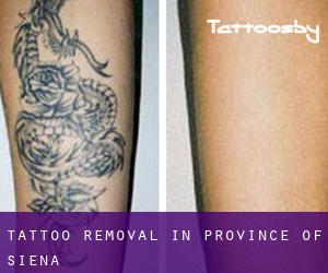 Tattoo Removal in Province of Siena
