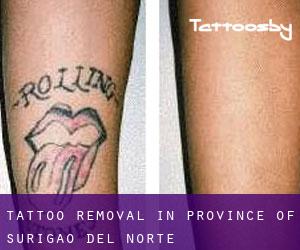 Tattoo Removal in Province of Surigao del Norte