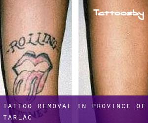 Tattoo Removal in Province of Tarlac