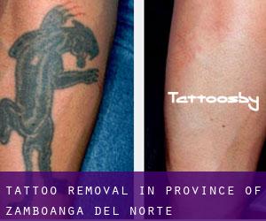 Tattoo Removal in Province of Zamboanga del Norte
