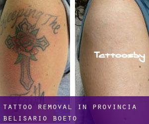 Tattoo Removal in Provincia Belisario Boeto