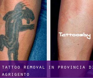 Tattoo Removal in Provincia di Agrigento