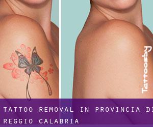Tattoo Removal in Provincia di Reggio Calabria