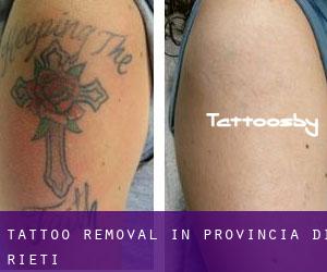 Tattoo Removal in Provincia di Rieti