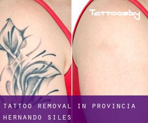 Tattoo Removal in Provincia Hernando Siles