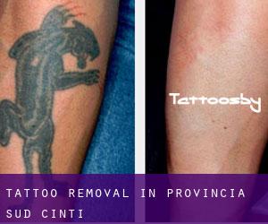 Tattoo Removal in Provincia Sud Cinti