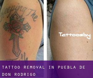 Tattoo Removal in Puebla de Don Rodrigo