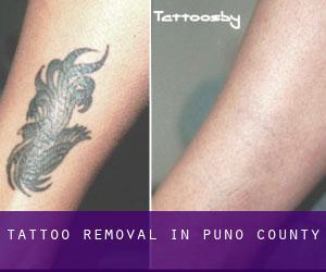 Tattoo Removal in Puno (County)