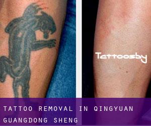 Tattoo Removal in Qingyuan (Guangdong Sheng)