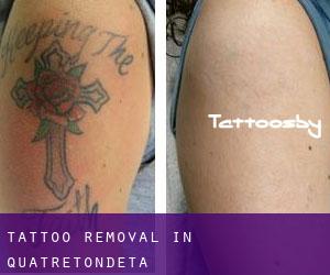 Tattoo Removal in Quatretondeta