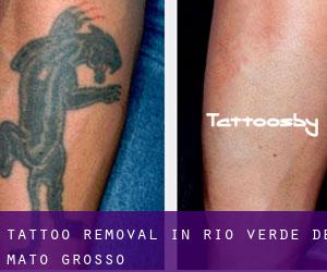 Tattoo Removal in Rio Verde de Mato Grosso