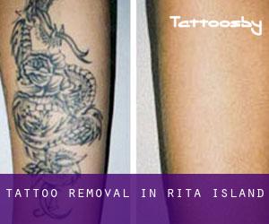 Tattoo Removal in Rita Island