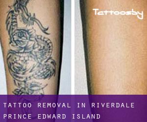 Tattoo Removal in Riverdale (Prince Edward Island)