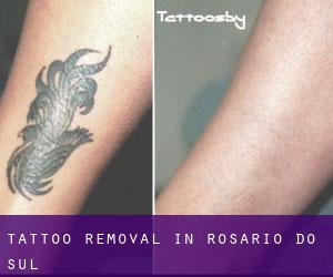Tattoo Removal in Rosário do Sul