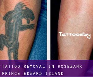 Tattoo Removal in Rosebank (Prince Edward Island)