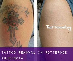 Tattoo Removal in Rotterode (Thuringia)