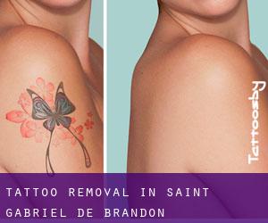 Tattoo Removal in Saint-Gabriel-de-Brandon
