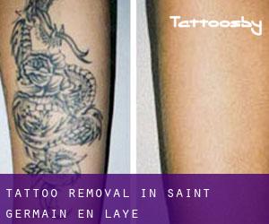 Tattoo Removal in Saint-Germain-en-Laye
