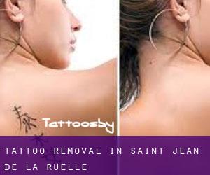 Tattoo Removal in Saint-Jean-de-la-Ruelle