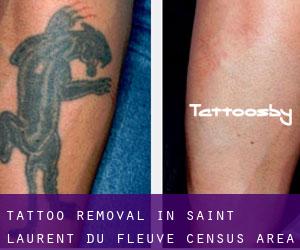Tattoo Removal in Saint-Laurent-du-Fleuve (census area)