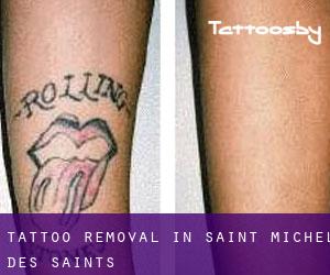 Tattoo Removal in Saint-Michel-des-Saints