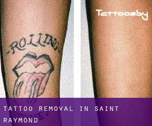 Tattoo Removal in Saint-Raymond