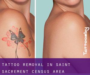 Tattoo Removal in Saint-Sacrement (census area)