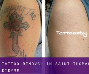 Tattoo Removal in Saint-Thomas-Didyme