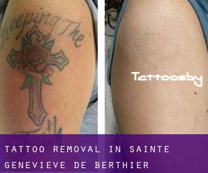Tattoo Removal in Sainte-Geneviève-de-Berthier