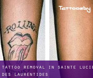 Tattoo Removal in Sainte-Lucie-des-Laurentides