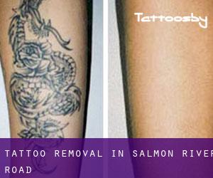 Tattoo Removal in Salmon River Road