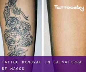 Tattoo Removal in Salvaterra de Magos