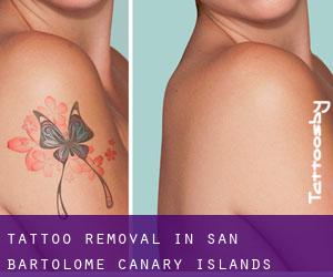 Tattoo Removal in San Bartolomé (Canary Islands)