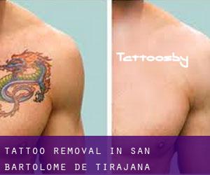 Tattoo Removal in San Bartolomé de Tirajana