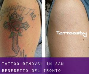 Tattoo Removal in San Benedetto del Tronto