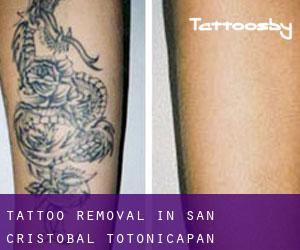 Tattoo Removal in San Cristóbal Totonicapán