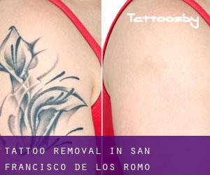 Tattoo Removal in San Francisco de los Romo