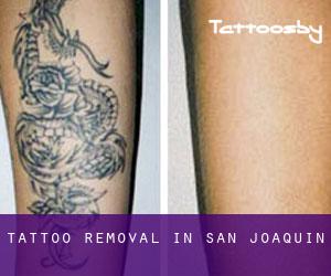 Tattoo Removal in San Joaquín