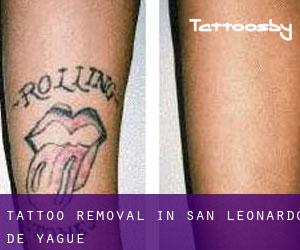 Tattoo Removal in San Leonardo de Yagüe