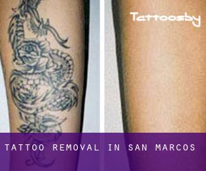 Tattoo Removal in San Marcos