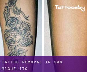 Tattoo Removal in San Miguelito